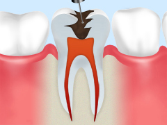 深い虫歯も治します！根管治療とは？