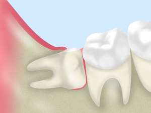 親知らずを抜歯する必要性