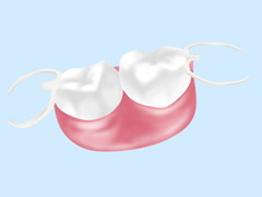 ホワイトクラスプ義歯