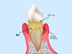 歯周病と加齢の関係