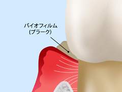 軽度の歯周炎