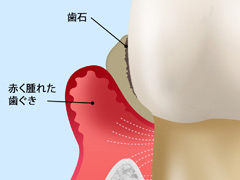 中等度の歯周炎