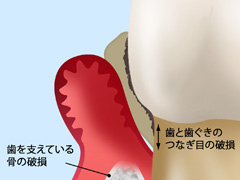 重度の歯周炎